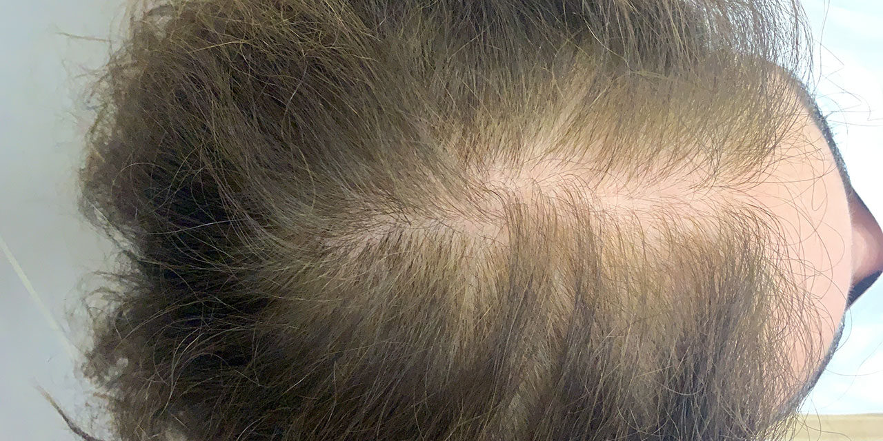 mesoterapia-capilar-