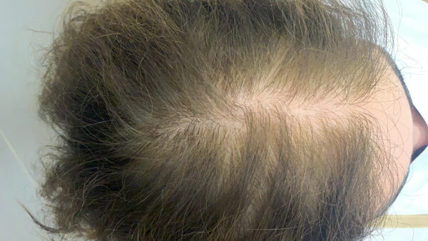 mesoterapia-capilar-