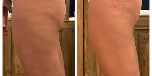 20221015-lanluma-estimulador-colageno